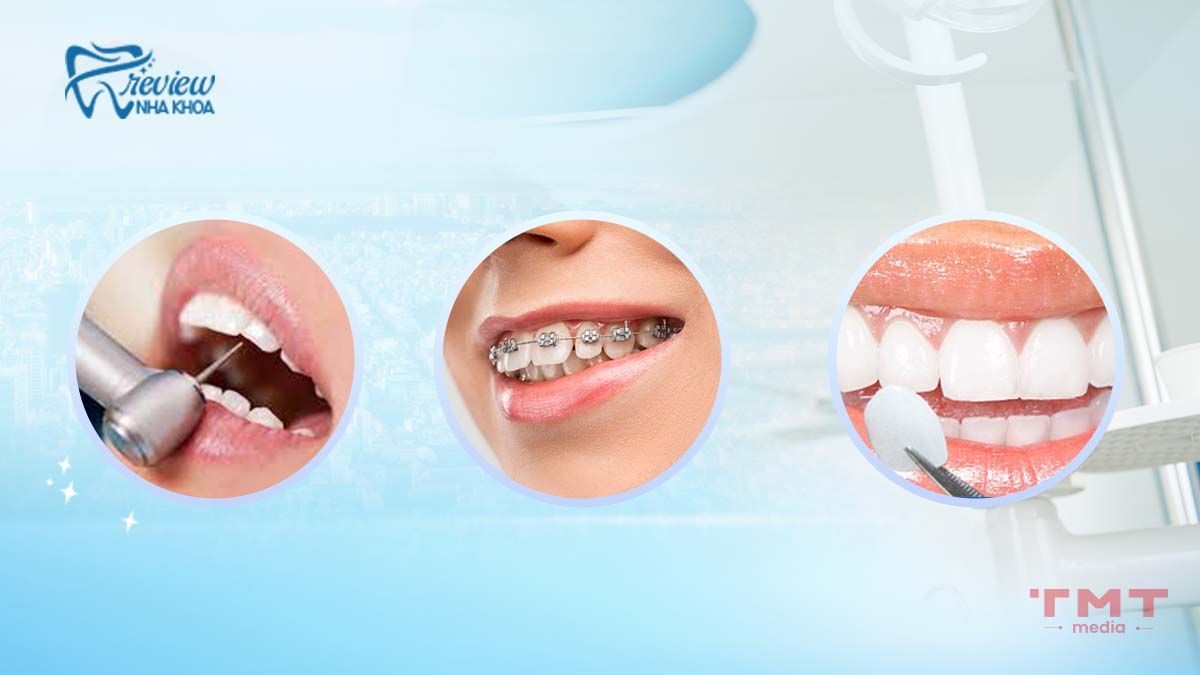 Cách chữa răng hô nhanh nhất bằng các phương pháp nha khoa
