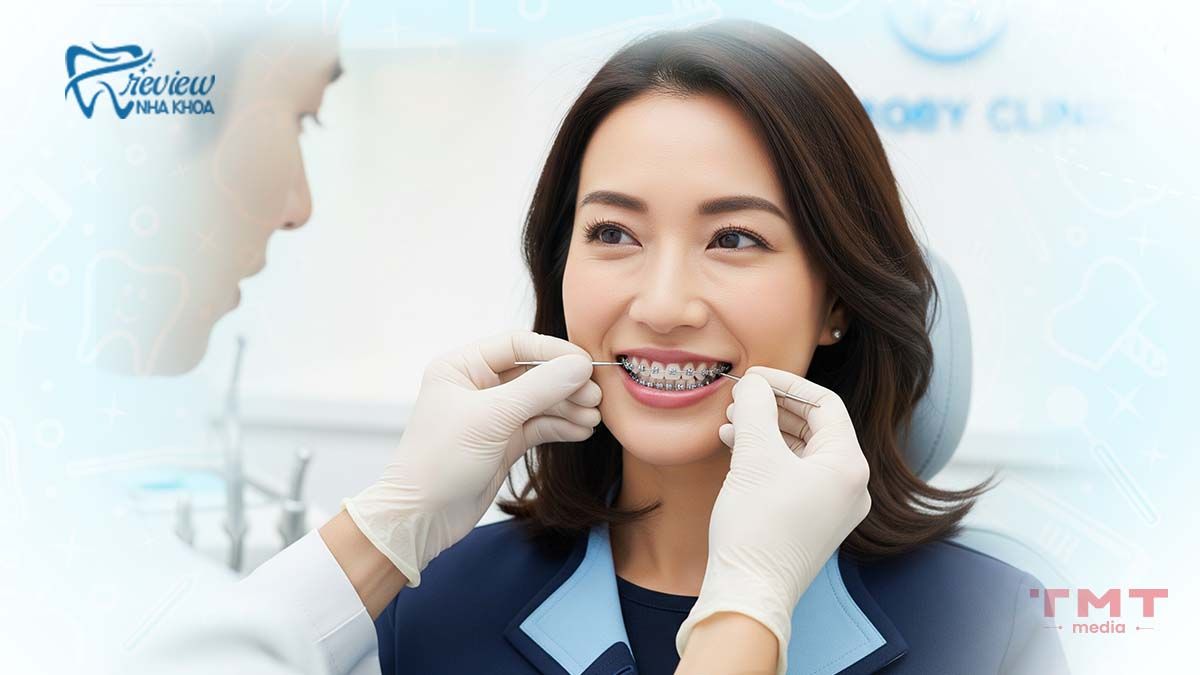 Người trưởng thành (trên 18 tuổi) niềng răng