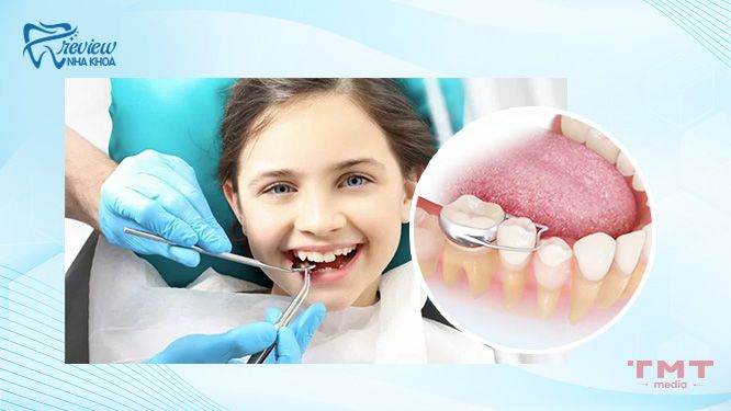 Giải pháp nào thay thế khi trẻ 14 tuổi chưa được trồng răng?