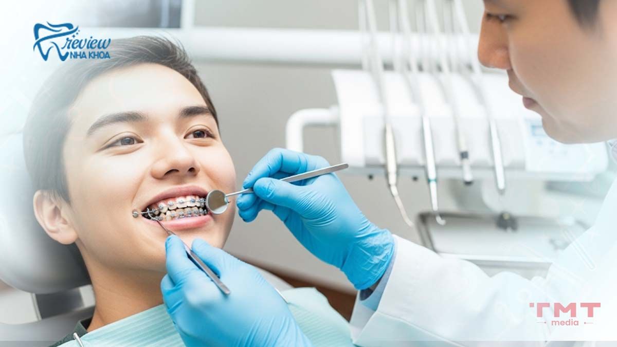 Niềng răng loại nào nhanh nhất? 