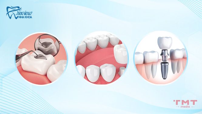 Các phương pháp điều trị sâu răng và phục hình răng cho trẻ 14 tuổi