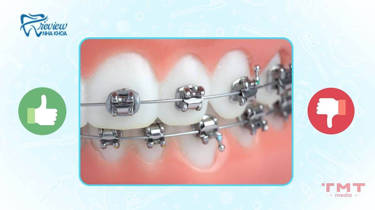 Ưu điểm và nhược điểm của niềng răng mắc cài kim loại tự đóng