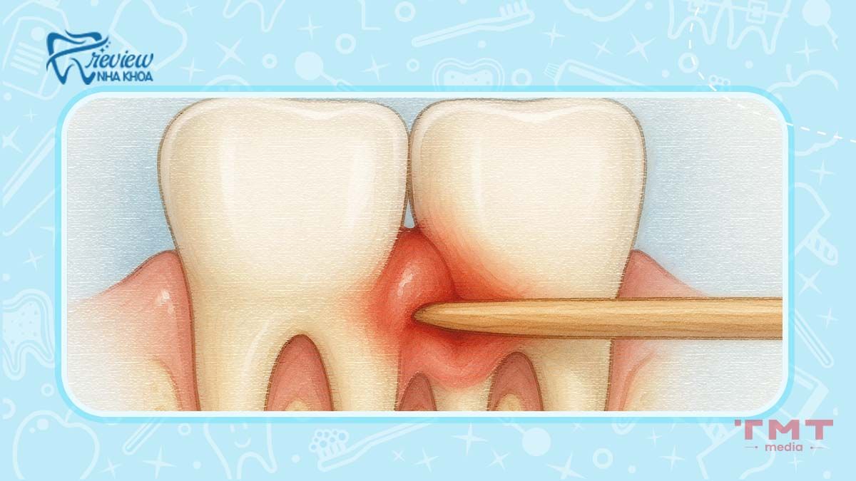 Nguyên nhân xỉa răng bị thưa răng