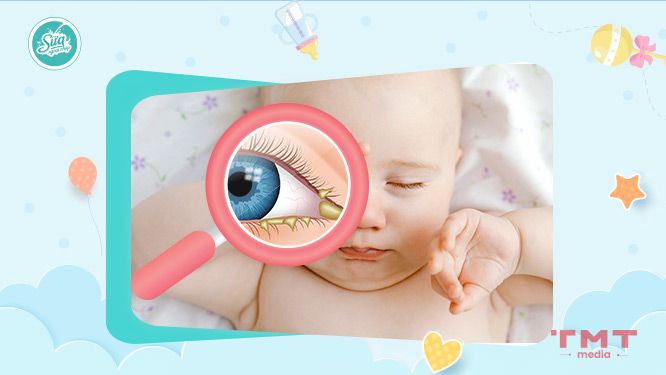 7 nguyên nhân khiến trẻ sơ sinh bị đổ ghèn vàng 1 bên mắt 