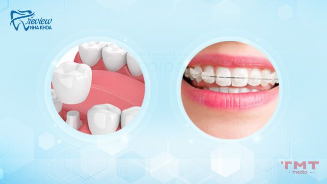 Phương pháp nha khoa khắc phục tướng răng miệng xấu
