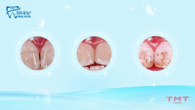 Những trường hợp dư thừa Fluor làm tổn thương răng