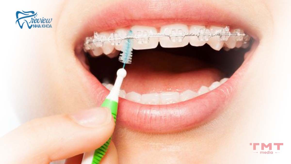 Hướng dẫn chăm sóc răng khi niềng mắc cài kim loại tự đóng