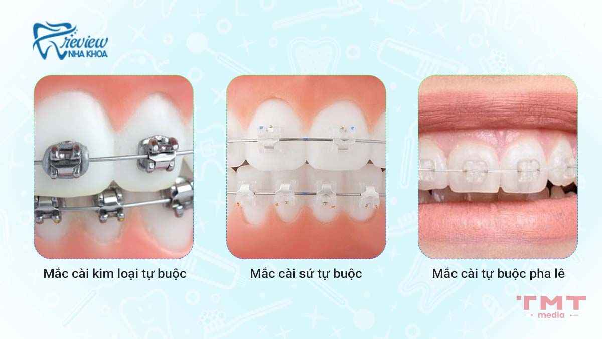 Các loại mắc cài tự buộc phổ biến hiện nay