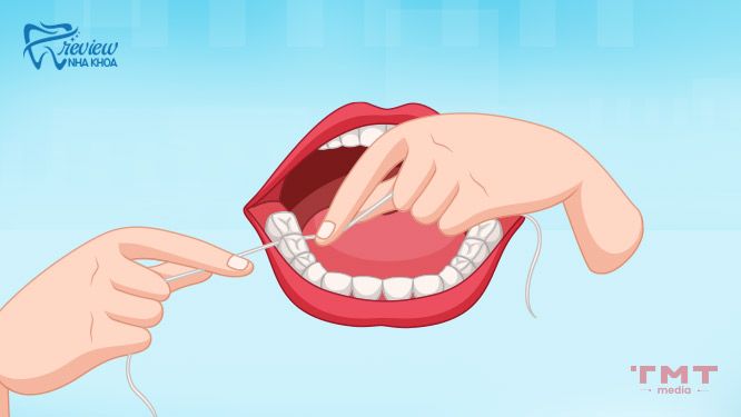 Sử dụng chỉ tơ nha khoa cho răng hàm
