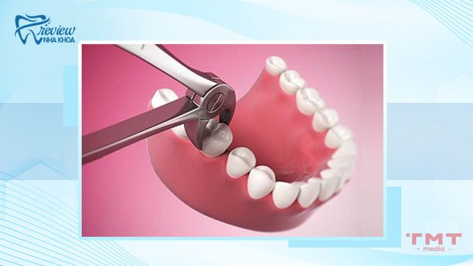 Răng vĩnh viễn bị lung lay có sao không? Có cần nhổ răng không?