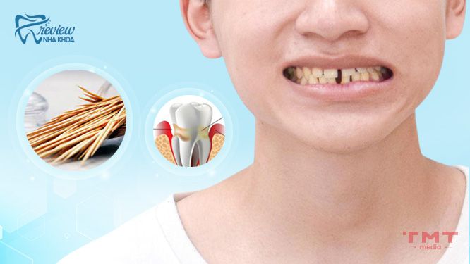 Thế nào là người có hàm răng thưa? Nguyên nhân gây thưa răng