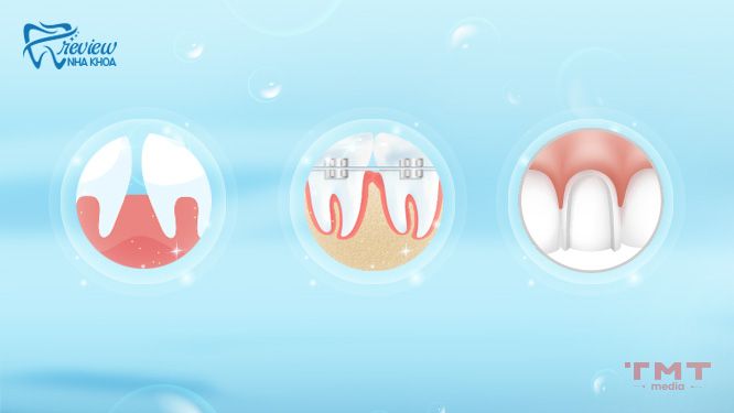 Hướng dẫn cách chữa răng bị nhiễm Fluor hiệu quả