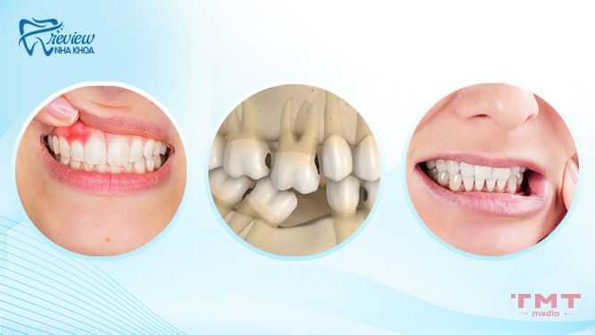Tại sao răng vĩnh viễn bị lung lay? Nguyên nhân chính