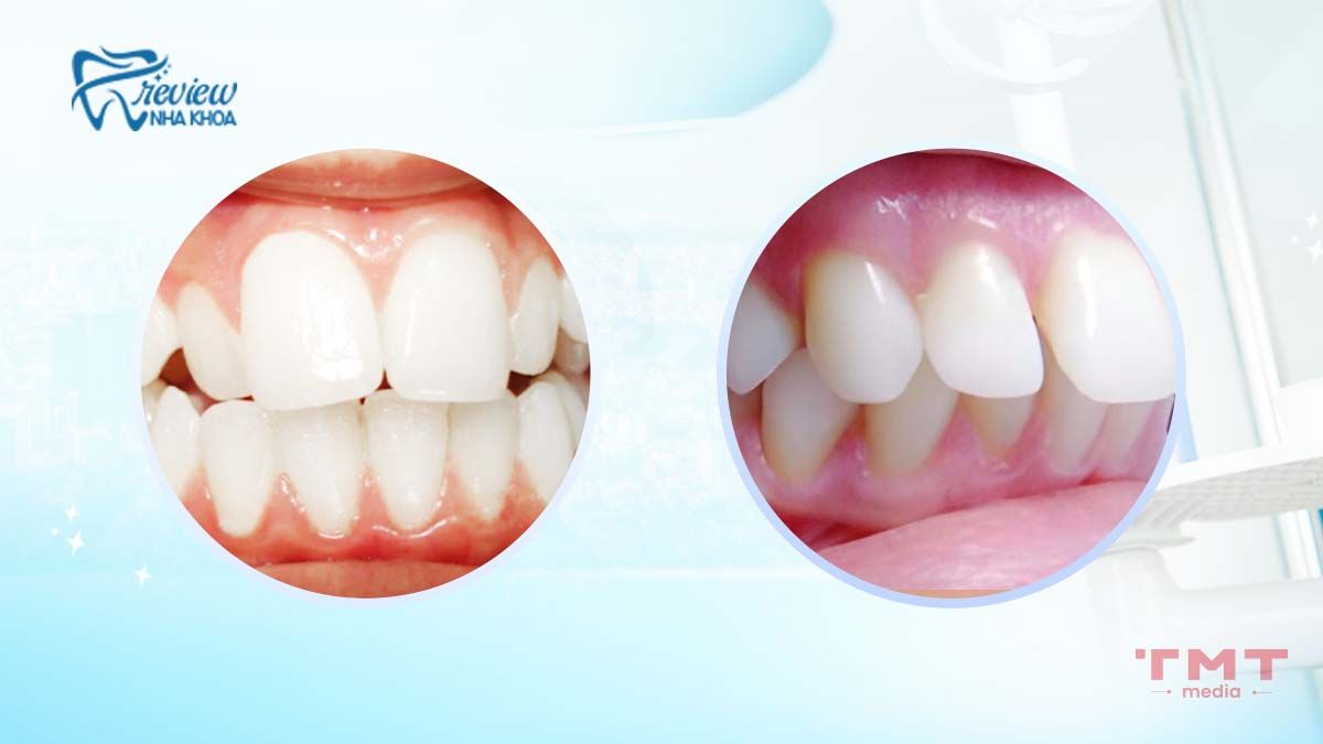 Những trường hợp nào có thể chữa ra hô bằng cách bọc răng sứ?