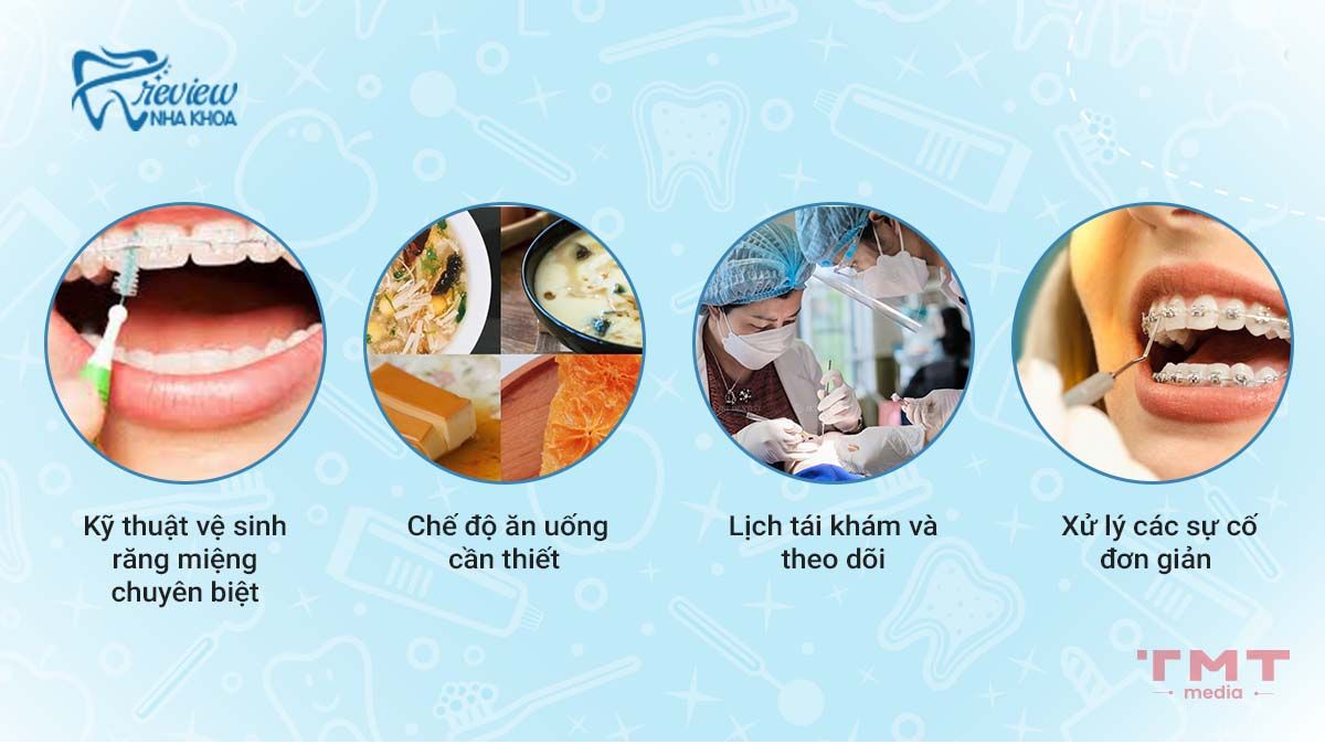 Kinh nghiệm khi niềng răng mắc cài tự buộc cần lưu ý