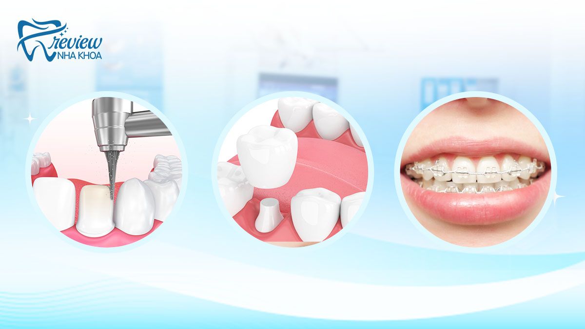 Một số cách chữa răng hô nhẹ hiệu quả hiện nay