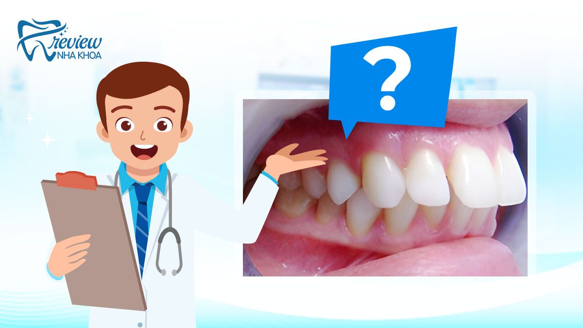 Một số câu hỏi liên quan về vấn đề răng bị hô