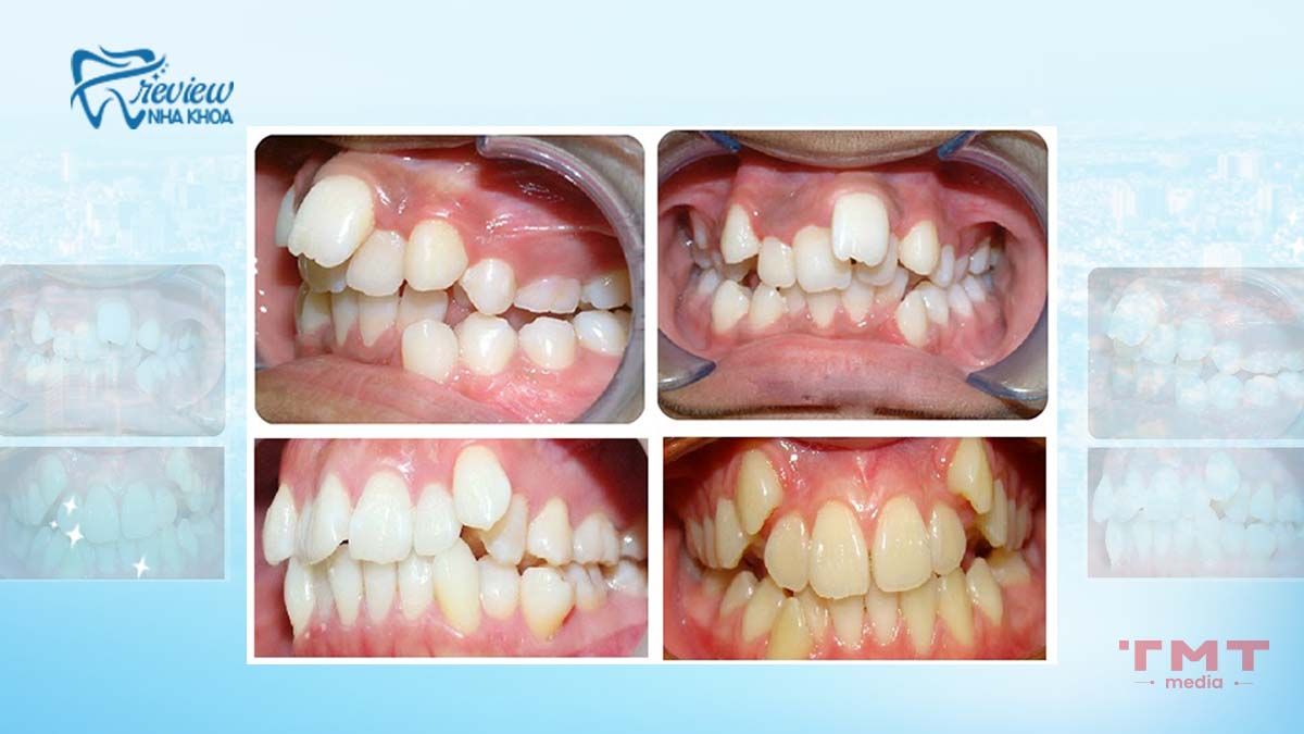 Răng lệch lạc là răng như thế nào? Dấu hiệu nhận biết
