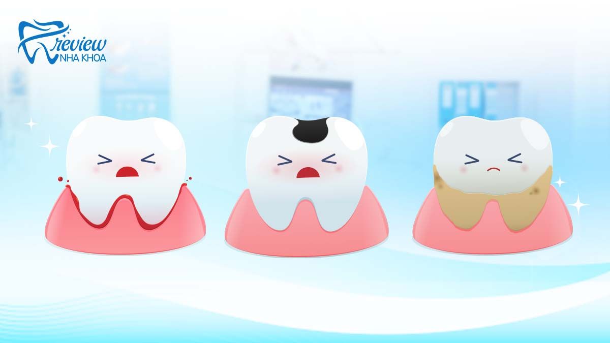 Những bệnh lý răng miệng thường gặp ở răng cấm