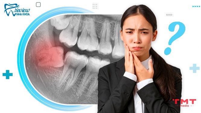 Tại sao mọc răng khôn lại bị đau
