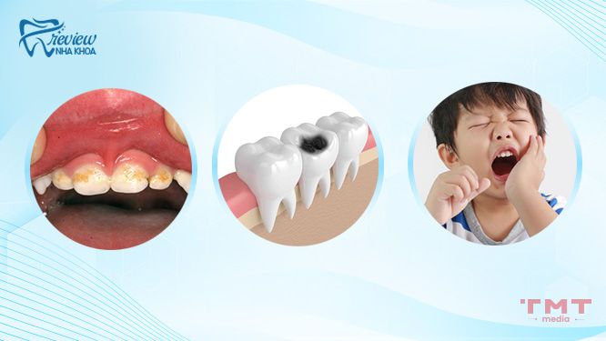 Dấu hiệu và nguyên nhân trẻ 5 tuổi bị sâu răng hàm