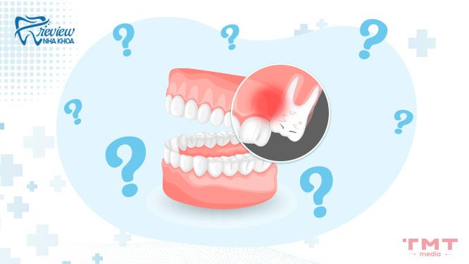 Tại sao răng khôn hàm trên bị đau