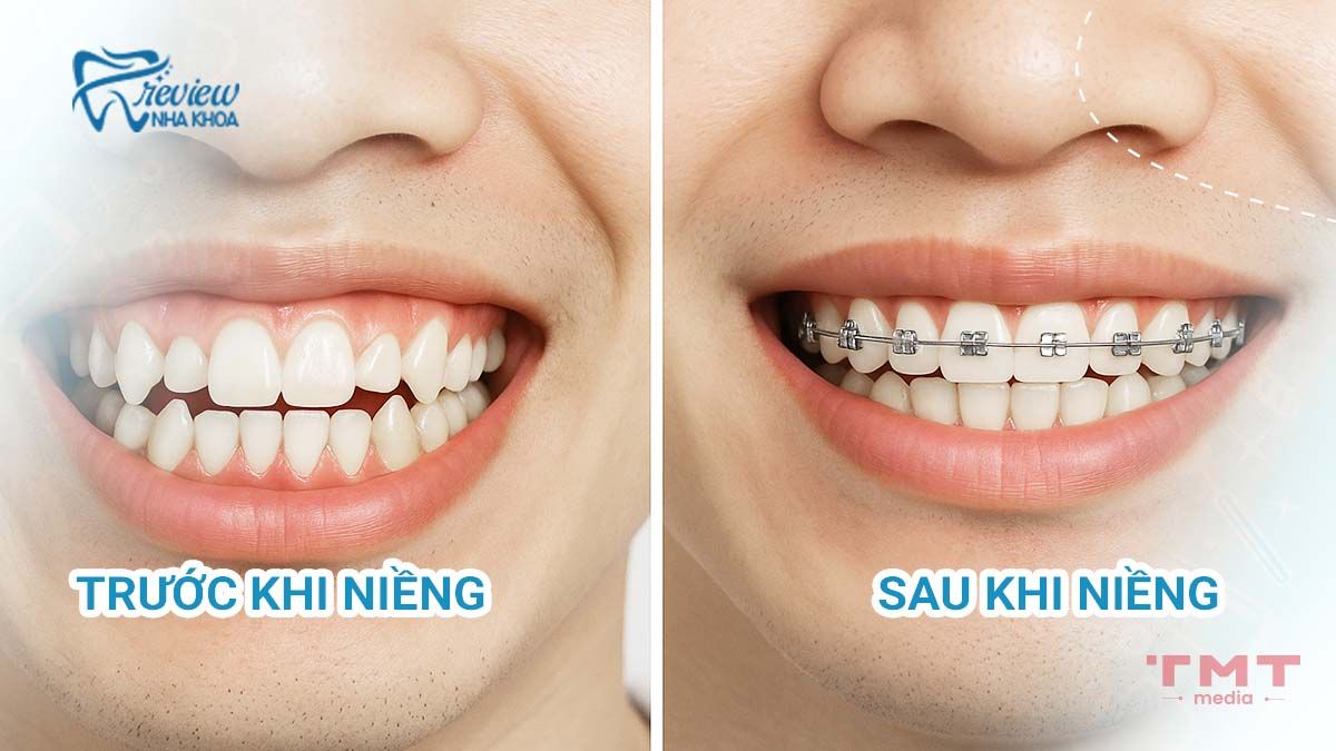 Niềng răng có giúp cải thiện hở lợi không?