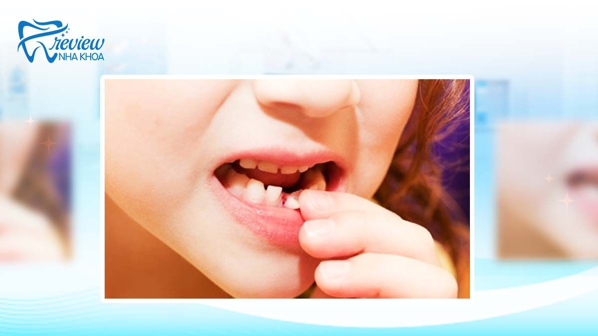 Dấu hiệu thay răng hàm ở trẻ