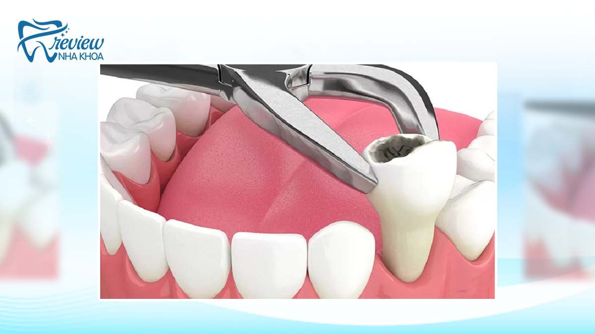 Có nên nhổ răng cấm không? Trường hợp nào cần nhổ răng cấm?
