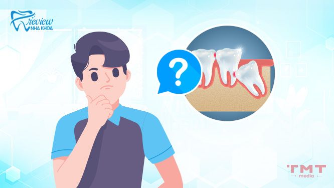 Con người có bao nhiêu chiếc răng khôn?