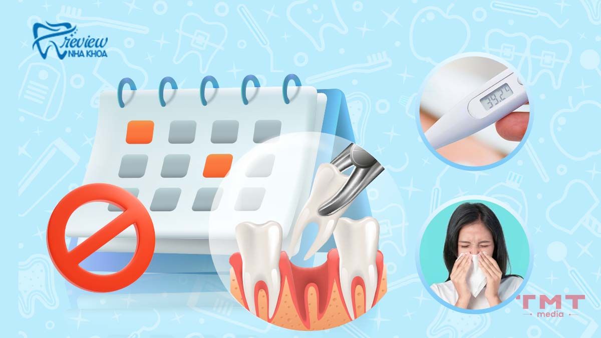 Không nên nhổ răng ngày nào theo nha khoa?