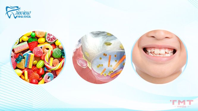 Nguyên nhân gây sâu răng ở trẻ 14 tuổi? Gây ra ảnh hưởng gì đến sức khỏe răng miệng
