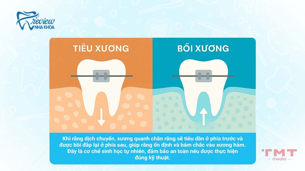 Cơ chế hoạt động của niềng răng: vì sao không làm yếu răng?