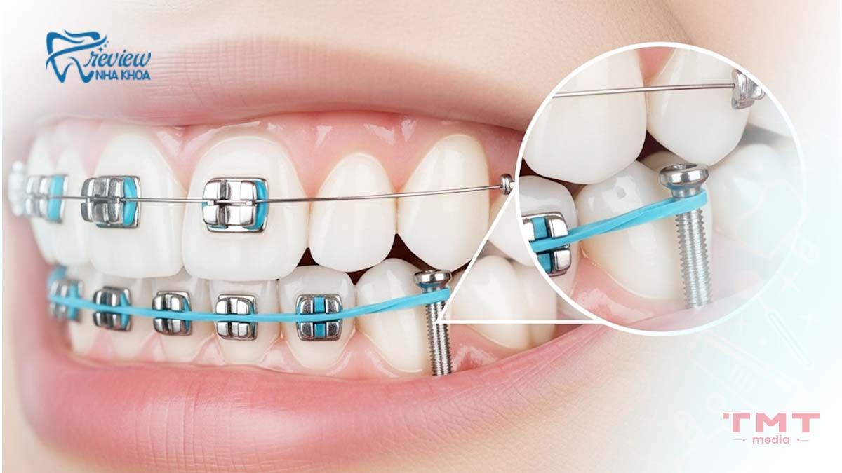 Cách khắc phục tình trạng hở lợi sau khi niềng răng
