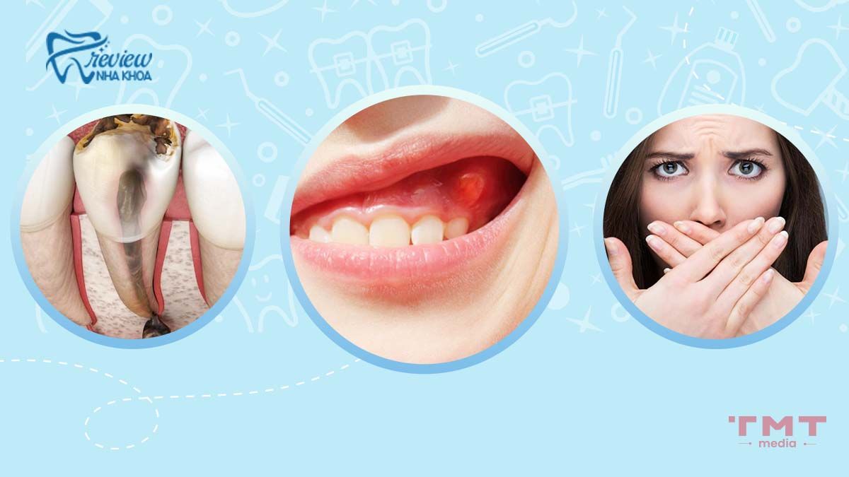 Nhổ răng không kịp thời gây ra hậu quả như thế nào?