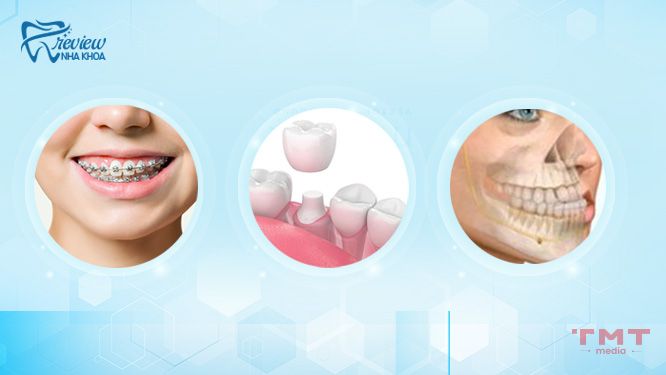 Các biện pháp khắc phục tình trạng răng quặp vào trong hiệu quả