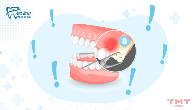 Lưu ý về cách chăm sóc sau khi nhổ răng số 8 hàm trên