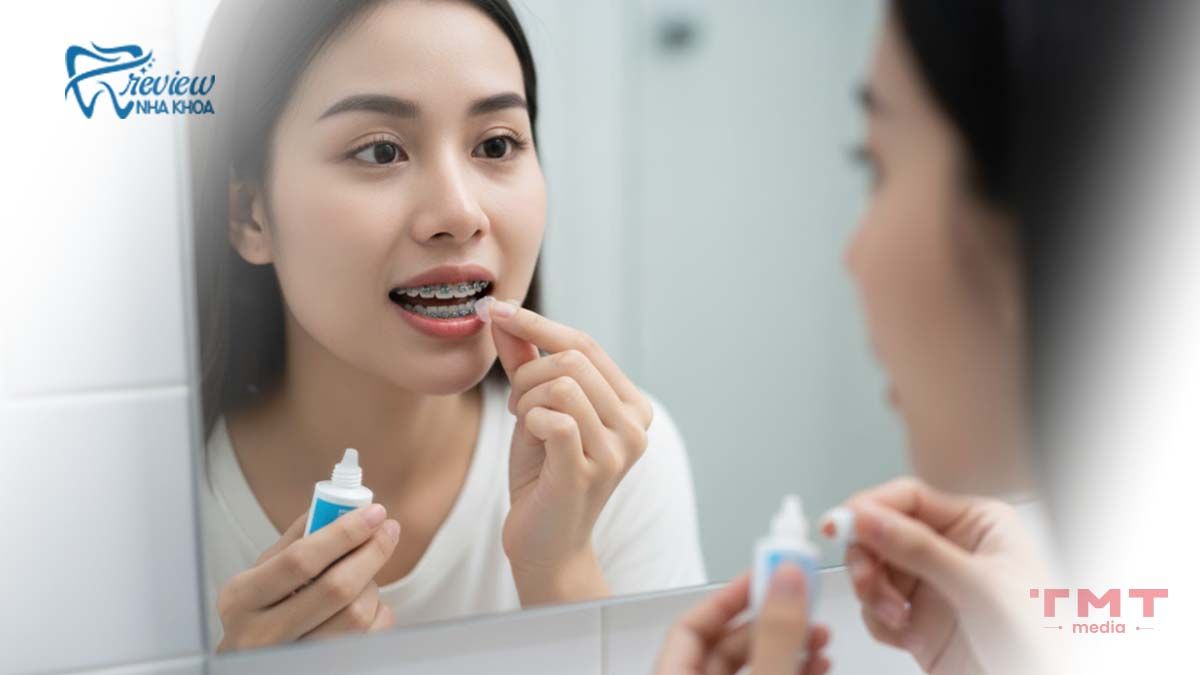 Bôi sáp nha khoa/gel giảm đau khi niềng răng tại chỗ