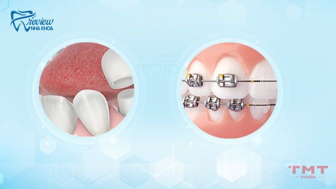 Làm sao để có hàm răng hợp phong thủy, sự nghiệp thăng tiến?