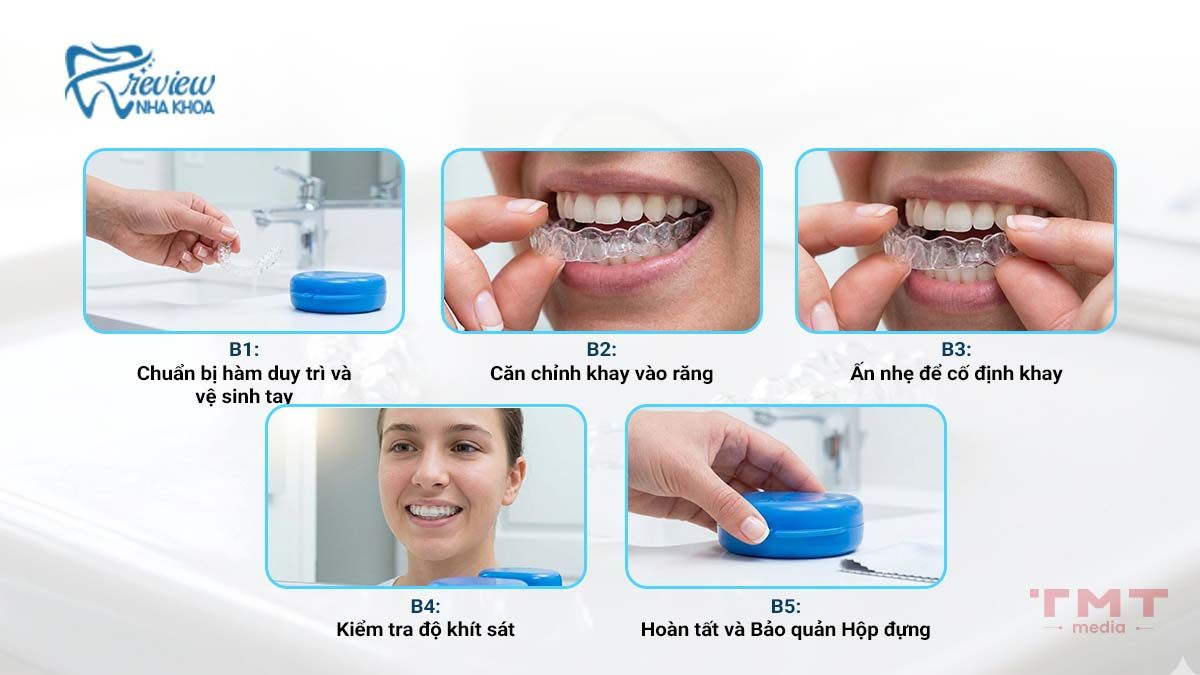 Cách đeo hàm duy trì trong suốt