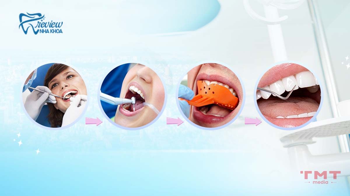 Quy trình bọc răng sứ hô ra sao?