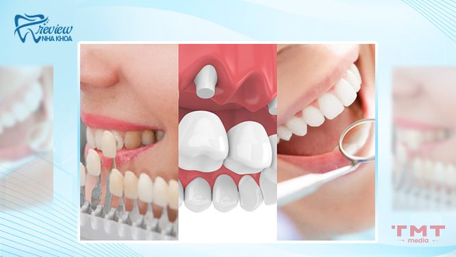 16 tuổi bọc răng sứ có ảnh hưởng gì đến sức khỏe răng miệng?