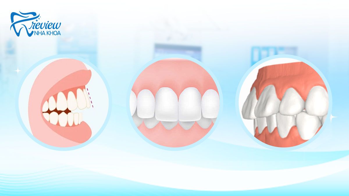 Cách nhận biết răng hô nhẹ
