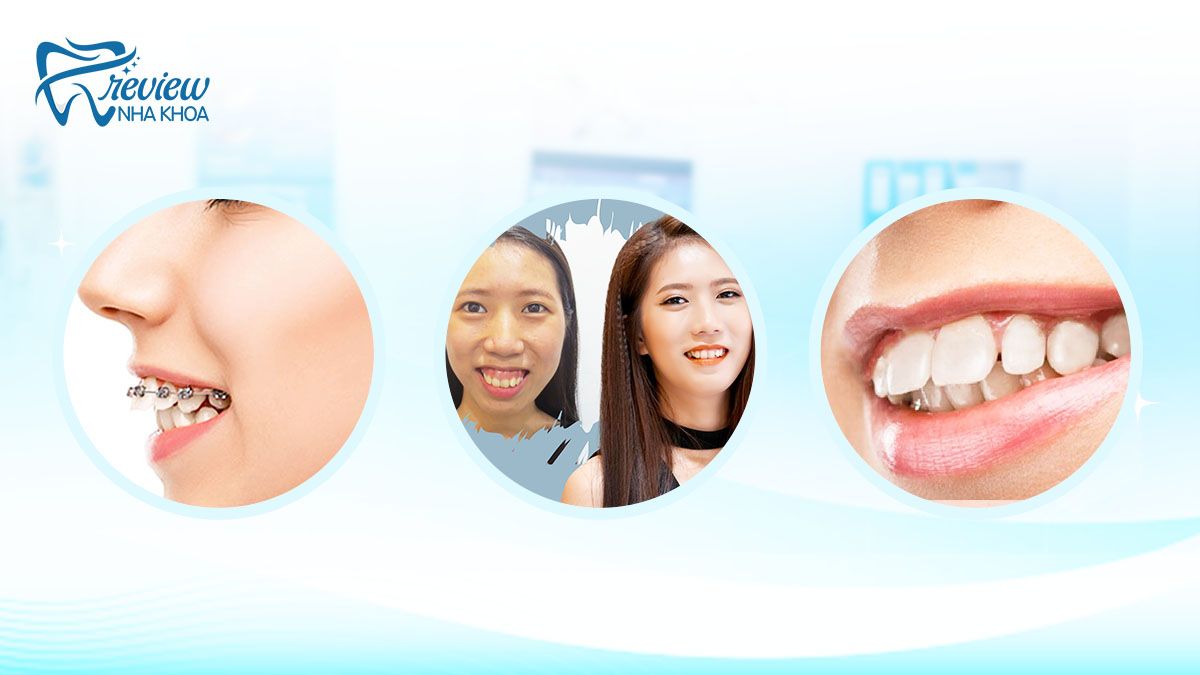 Làm thế nào điều trị được chứng răng vẩu nặng