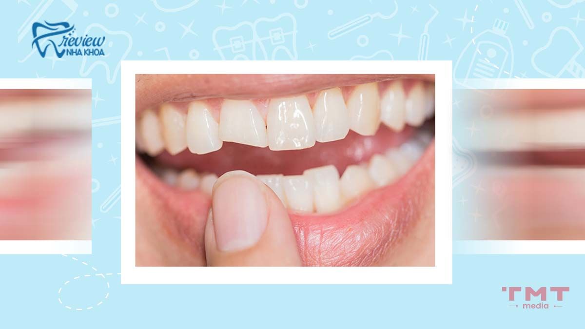 Bị mẻ răng có điềm gì? Tốt hay xấu?
