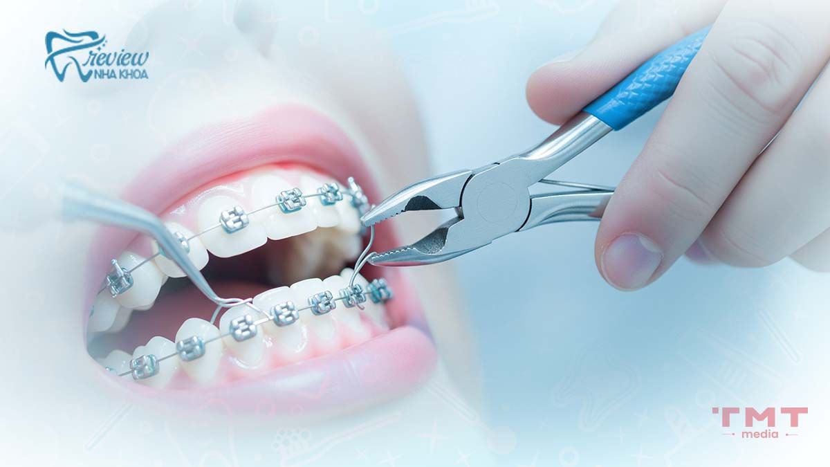 Giai đoạn 4: Hoàn thiện và tinh chỉnh khớp cắn