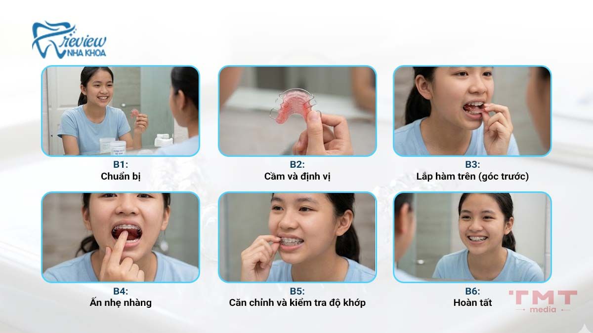 Cách đeo hàm duy trì kim loại (Hawley)