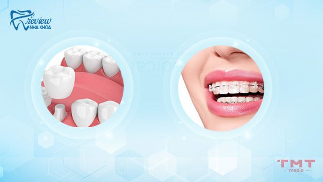 Phương pháp nha khoa điều chỉnh tướng răng hổ hiệu quả