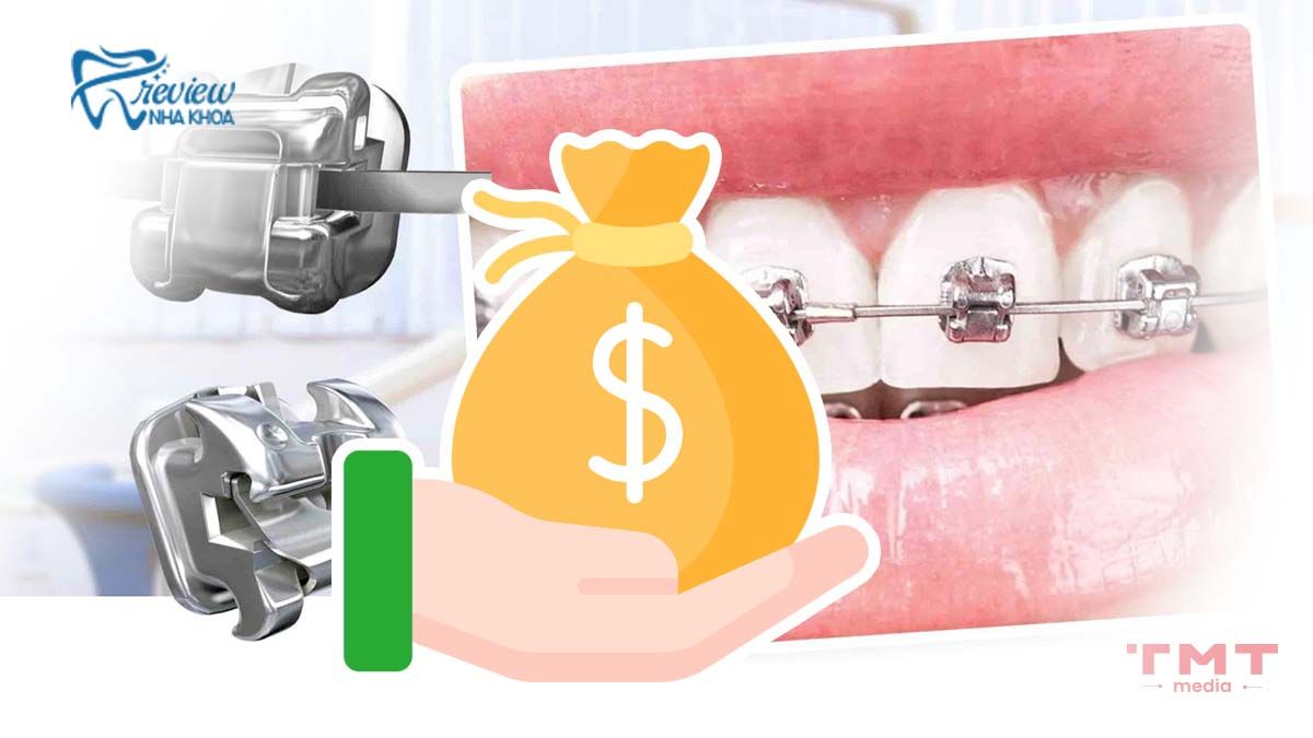 Chi phí niềng răng mắc cài kim loại tự buộc giá bao nhiêu?