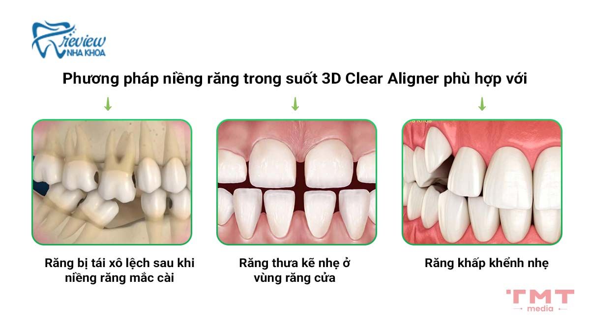 Ai phù hợp và ai không phù hợp với niềng răng Clear Aligner?